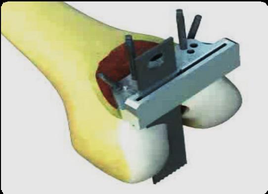 15. Distal (uzaktaki, uçtaki) Femoral Kesme Bloğu 0, +2 ve +4 diye işaretlenmiş 3 çift delik sunar.