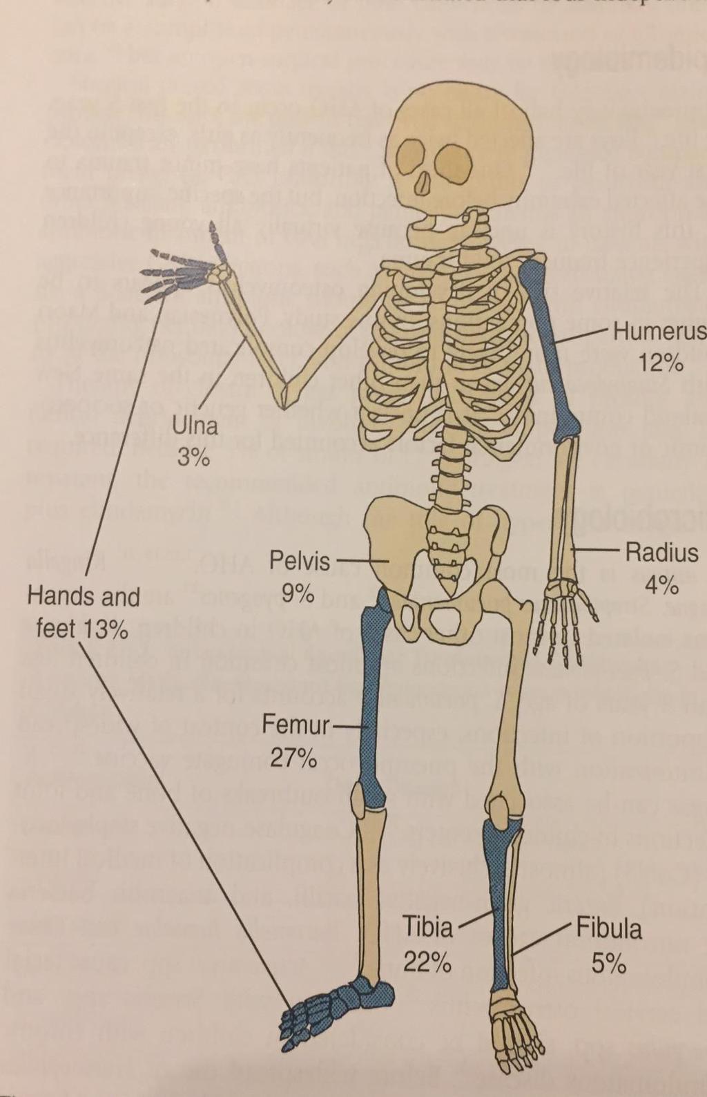 Osteomiyelit Sıklıkla uzu ke ikler etkilenir ve genellikle