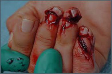 DĠJĠTAL SĠNĠR BLOKLARI Parmak ucu yaralanmaları (finger-tip injuries)