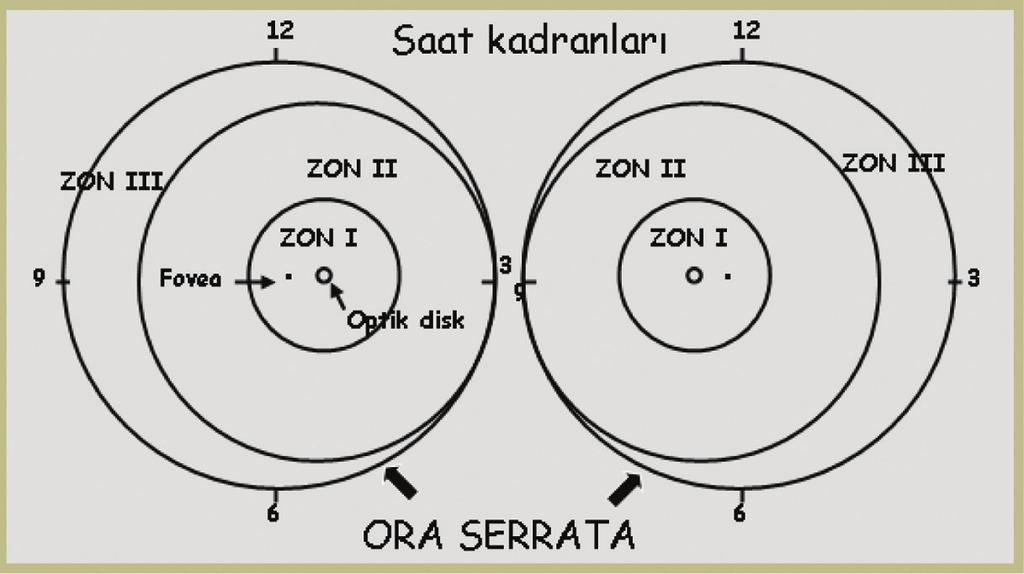 104 Prematüre Retinopatisi Tedavisi ROP UN SINIFLANDIRILMASI Prematüre bebeklerin tarama, takip ve tedavisini objektif bir şekilde yapabilmek için ROP ilk kez 1984 yılında uluslararası ROP