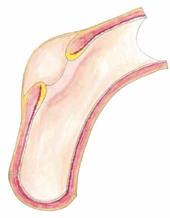 Anterior veya posterior sirkulasyonda görülebilmekle birlikte en çok supraklinoid internal karotid arter (IKA) de görülür (22,25).