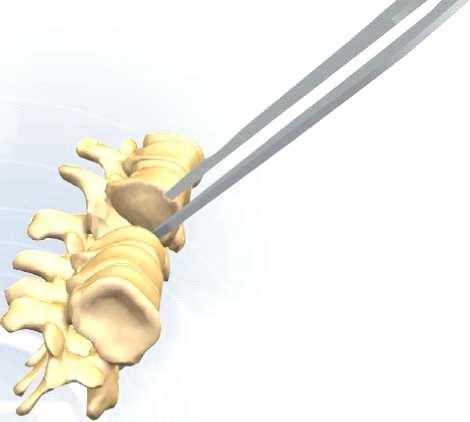 EPANDABLE CORPECTOMY CAGE Enposure Açma İşlemi EN Determine the correct approach. The involved segment(s) of the vertebral column are exposed.