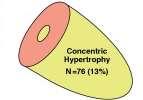 KBH da sol ventrikül hipertrofisi patojenezi ile ilgili klasik (ve oldukça basitleştirilmiş!) açıklamamız.