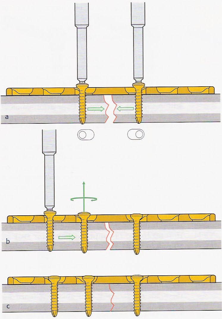 17 Distraksiyon kuvvetine maruz kalan ve aynı zamanda kırık hattında kompresyon sağlayan plaklar kompresyon plağı olarak, kemiğin gerilme yüzeyine uygulanıp torsiyonel, bükülme, kompresyon ve