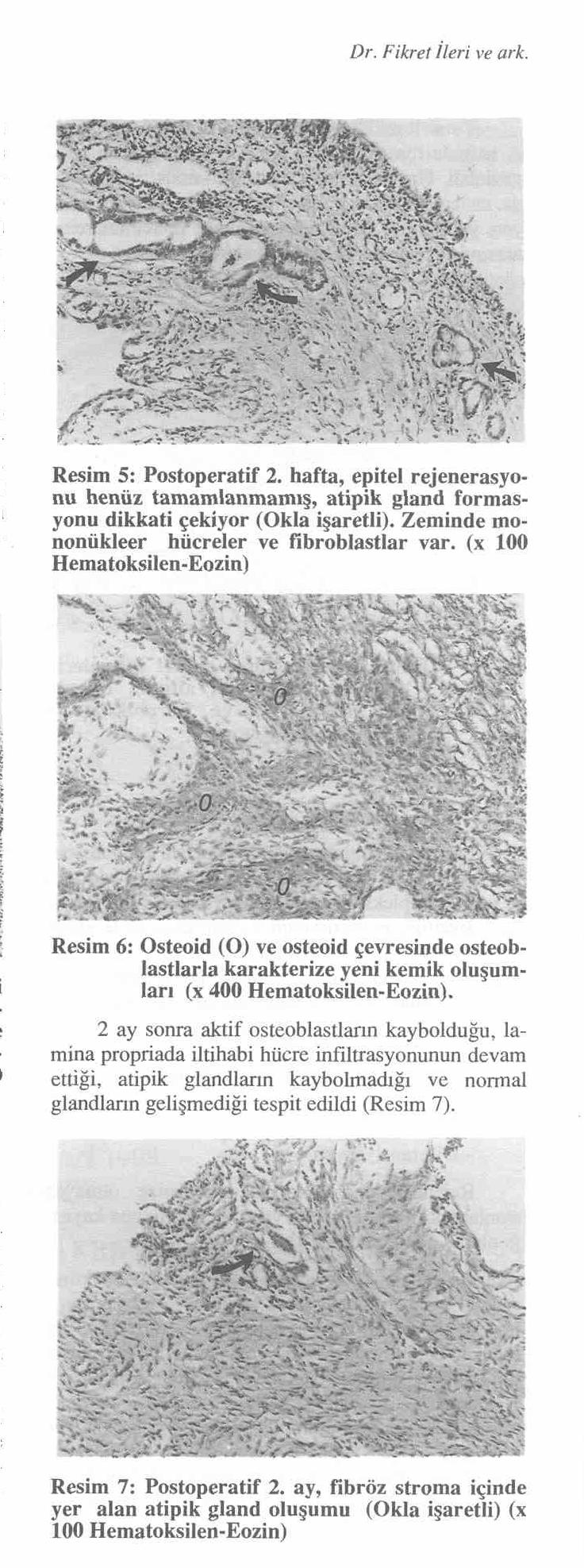 K.B.B. ve Baş Boyun Cerrahisi Dergisi, 4 :2-157-161 Postoperatif birinci haftada, parsiyel rezeksiyon yapılan deneklerde reepitelizasyonun başladığı ve epitelizasyon adacıklarında yer yer silyaların