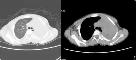 82 Şevval Eren Fatih Meteroğlu Resim 5a: Gecikmiş tanılı sol ana bronş rüptürü ve atelektazinin toraks tomografisi görünümü Resim 5b: Gecikmiş tanılı sol ana bronş rüptürünün preoperatif ve