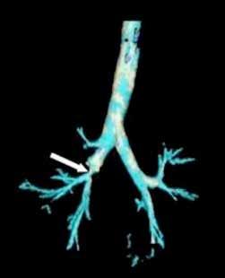 BÖLÜM 8 Trakeobronşiyal Sistem Travmaları 79 Resim 2: Üç boyutlu tomografide sağ intermedier bronşta stenoz görünümü Resim 3: Fallen lung ve pnömotoraksın röntgen ve toraks BT görünümü