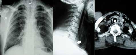BÖLÜM 8 Trakeobronşiyal Sistem Travmaları 81 Resim 4: Ateşli silah yaralanmasına ait mermi çekirdeği, röntgen ve tomografi görüntülerinde trakea içinde görülmekte Bronkoskopi sayısının üst sınırı