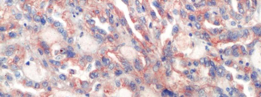 Resim 5: Papiller tip tümörde CAIX sitoplazmik membran boyanması (X200) Çalışmamızda 61 olguyu kapsayan şeffaf hücreli tümör grubunda makroskopik tümör çapları ile cyclin D1, ki67, p27, p53, CAIX