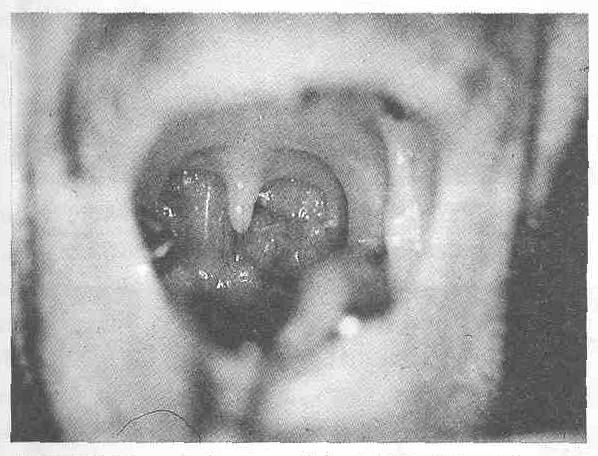 Resim 2: Mikrovasküler anastomozların tamamlanmasından sonra serbest önkol flebinin görünümü Diğer bir hastaya (Olgu - 4) total larenjektomi ve parsiyel farenjektomi uygulanmasını takiben serbest