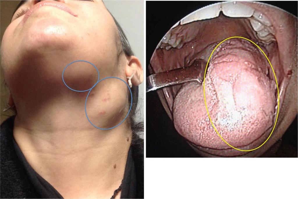 Seviye II (Üst Juguler Grup) lenf nodları, oral cavite, nasal cavite, nazofarenks, orofarenks, hipofarenks, larenks, ve parotid gland kanserlerinde; Seviye III (Orta Juguler Grup) lenf nodları, oral