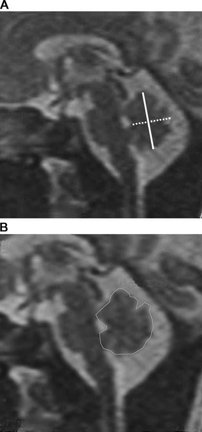 Şekil 19: Vermis yüksekliği, anteroposterior çap (39).