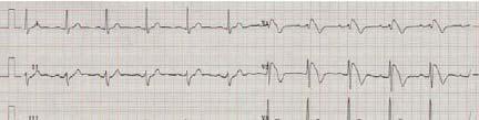 Brugada ve Erken Repolarizasyon EKG bulguları 39 Yaş Erkek Hasta Brugada Sendromunda;