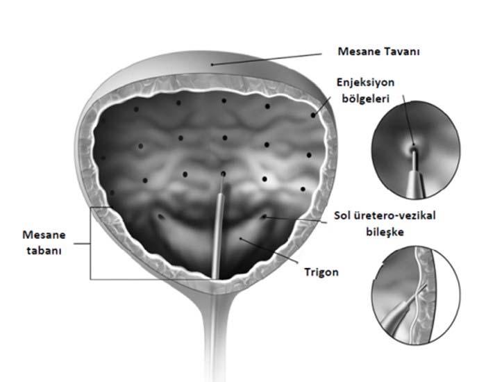 BOTOX 9 aya kadar sürebilen, geçici kimyasal