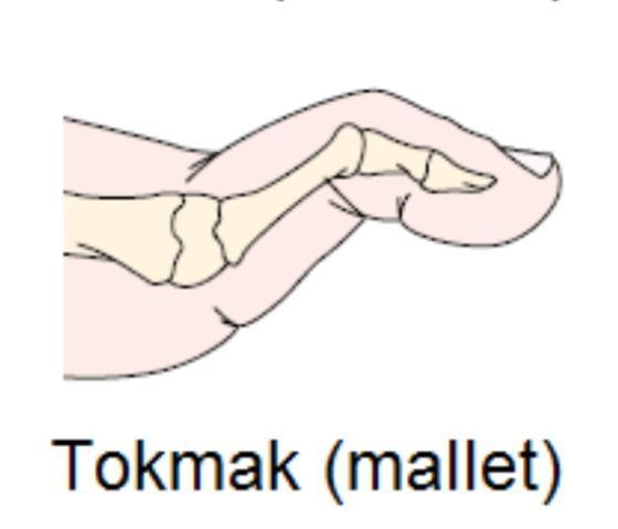 DİP eklem fleksiyonda sabittir. Fikse olan parmak ucunda nasır gelişebilir.