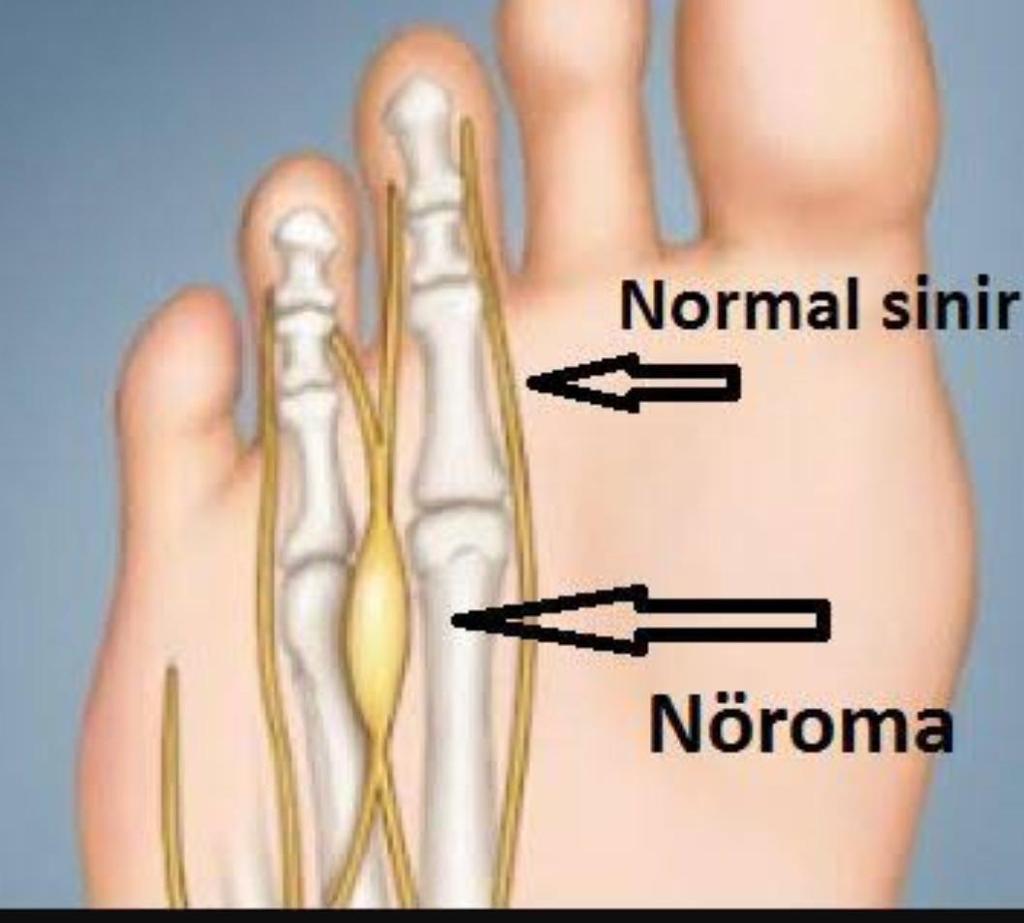 MORTON NÖROMASI İnterdijital sinirin kompresif nöropatisidir, periferal fibrozistir. En sık 3.4. metatarslar arasında, daha az sıklıkla da 2.3. metatars arasında bası altında kalır.