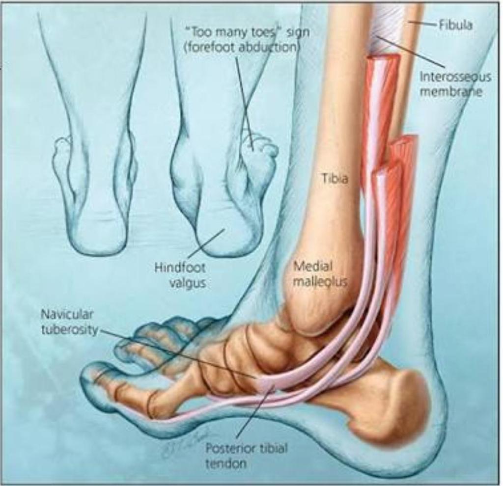 POSTERİOR TİBİAL TENDON YETMEZLİĞİ Genelde tek taraflıdır ve 45-65 yaş arasındaki kadınları etkiler.