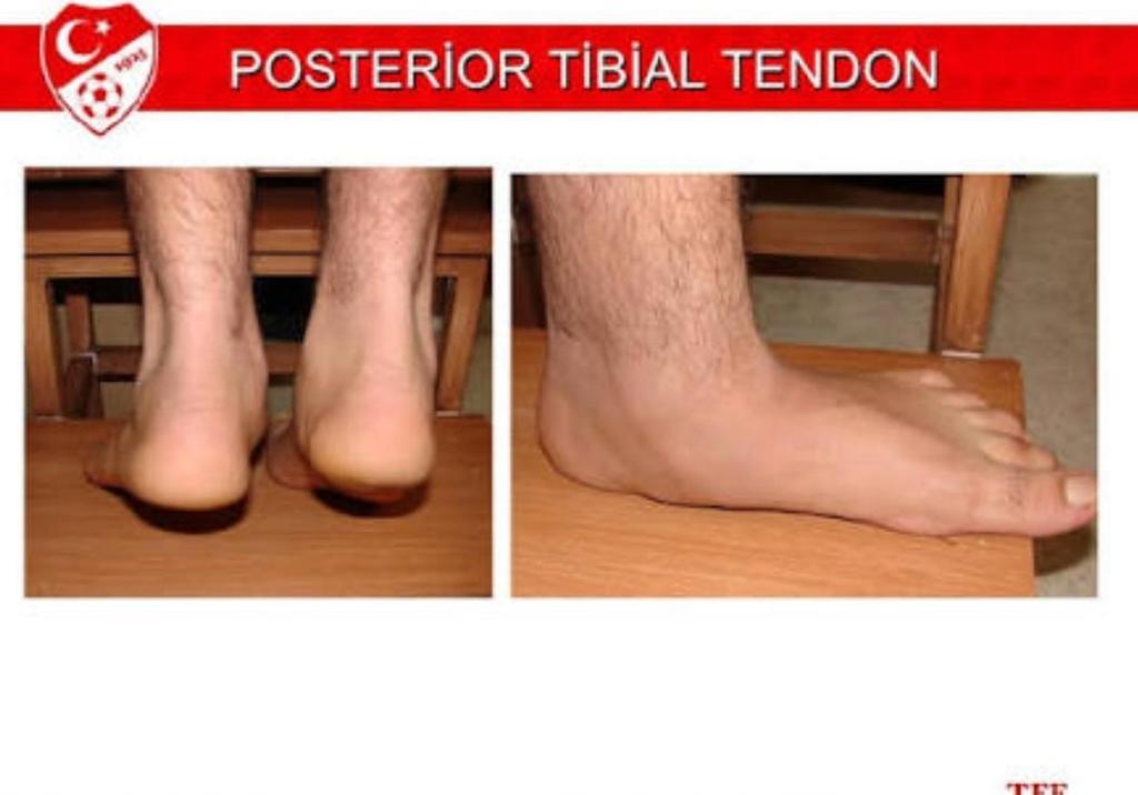 POSTERİOR TİBİAL TENDON YETMEZLİĞİ Topuk kalkışı hastanın arkasinda durularak bilateral yapılmalıdır.