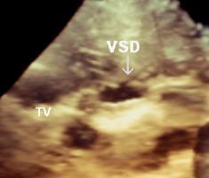 lu olgu). Ao: Aort, RA: Sağ atriyum, TV: Triküspit kapak, VSD: Ventriküler septal defekt.