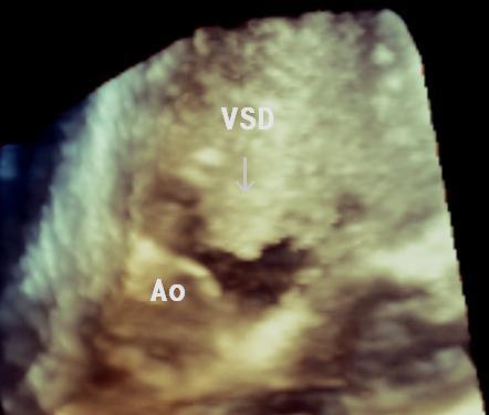 İzole olmayıp kompleks konjenital kalp hastalıklarının bir komponenti olarak görülen VSD lerde de 3-B EKO ile VSD nin konumu, morfolojisi, VSD-Ao ilişkisi, defekt çapları ve alanı değerlendirilebildi