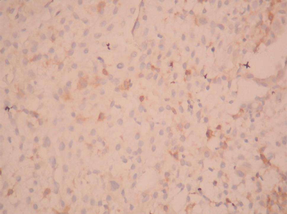 gebelik haftas nda 3. kayb ndan elde edilen desiduan n görünümü. CD4+ T-helper lenfositlerin görece az say da olmas ve seyrek da l m görülmektedir. fetal geliflimde kritik öneme sahiptir.