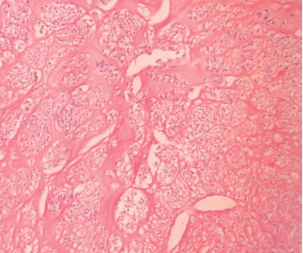 10. Ulusal Obstetrik ve Jinekolojik Ultrasonografi Kongresi, 27 30 Eylül 2018, Dalaman rafi sonucunda uterin fibroid saptanm fl ve histerektomi endikasyonu konulmufl 6 olgu incelendi.