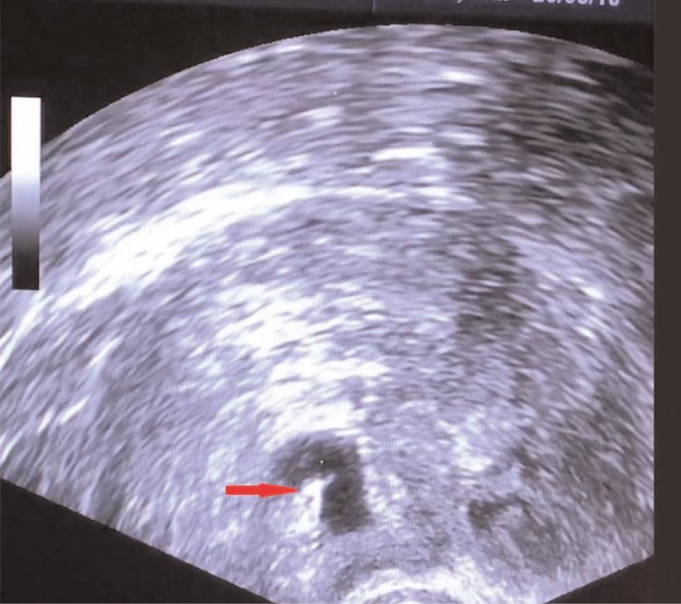 D&C iflleminden 1 gün sonra taburculu u yap lan hastalar n serum beta-human chorionic gonodotropin (hcg) s f rlanana kadar 1 hafta arayla takipleri yap lm flt r.