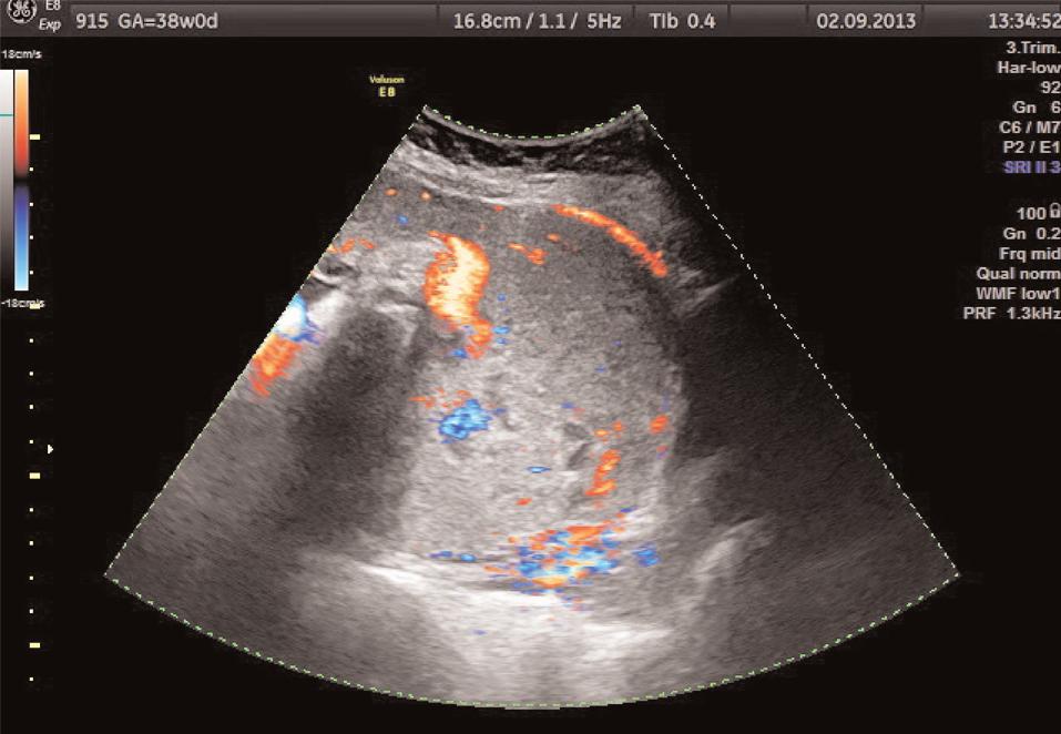 10. Ulusal Obstetrik ve Jinekolojik Ultrasonografi Kongresi, 27 30 Eylül 2018, Dalaman MHz broadband konveks prob ile deneyimli ve Ductus Venosus ve Doppler uygulamalar için Fetal Medicine Foundation