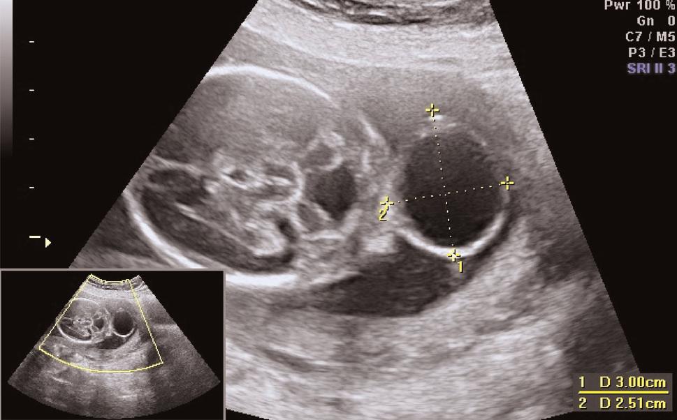 Sözlü Bildiri Özetleri ﬁekil 1 (SB-37): Oksipital bölge meningosel görünümü (3 3 cm). ﬁekil 2 (SB-37): Lateral ventrikül ölçümü (12 mm).