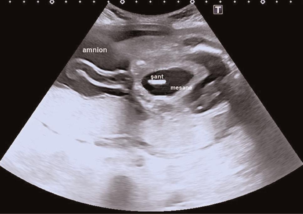 Sözlü Bildiri Özetleri Tablo 1 (SB-38): Olgunun fetal üriner analiz de erleri. Analit Sonuç yi Prognoz Kötü Prognoz Sodyum 64.9 mmol/l <90 mmol/l >100 mmol/l Klor 56.