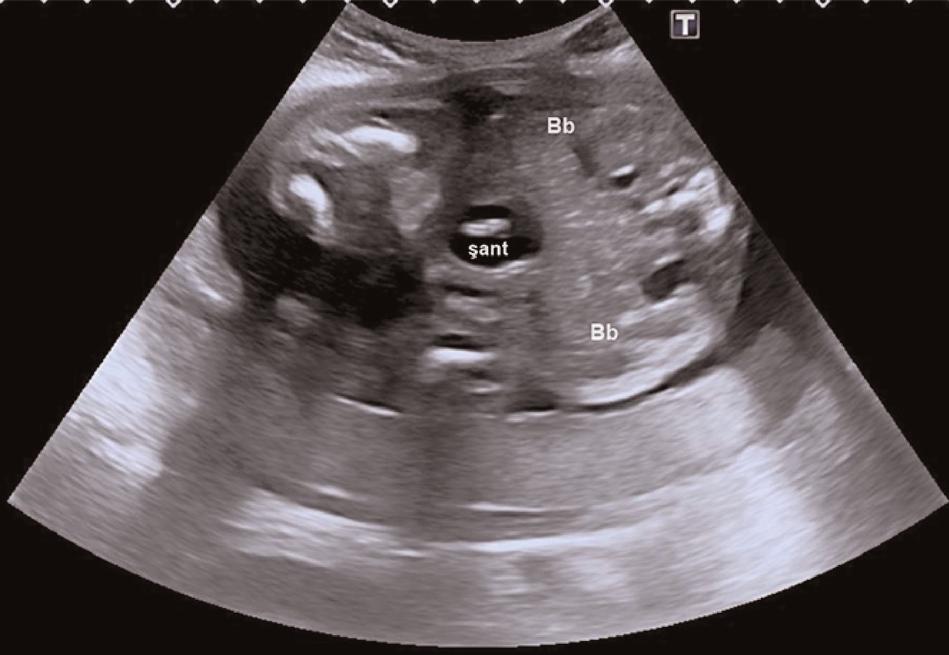 4 mg/dl <20 mg/dl >40 mg/dl SB-38) ve üreteropelvik dilatasyonda gerileme gözlendi (fiekil 2 SB-38). 33. gebelik haftas nda amniyon s v s ve mesane boyutlar normal olarak de erlendirilen hastan n 34.