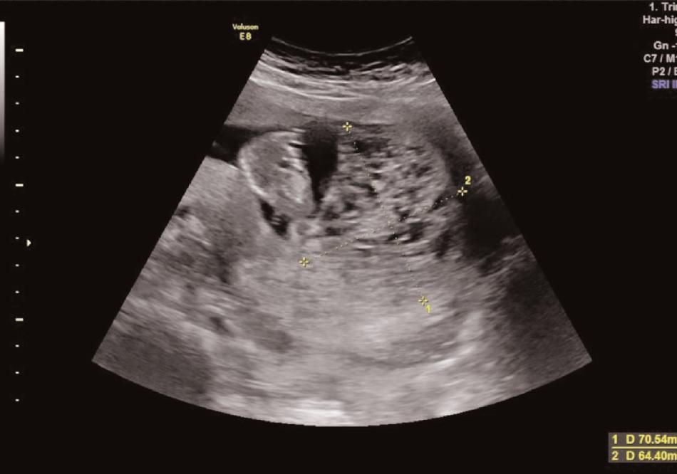 10. Ulusal Obstetrik ve Jinekolojik Ultrasonografi Kongresi, 27 30 Eylül 2018, Dalaman Tablo 3 (SB-40): Termine edilen fetal anomalili gebeliklerin anomali tipine göre da l m.