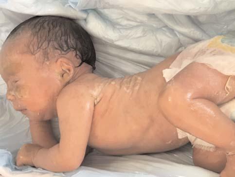 Bebek yo un bak mda yatt süre içinde dehidratasyondan korunmak için parenteral nutrisyon ile beslendi. Cilt için nemlendiriciler ve antibiyotikli merhemlerle pansuman ve debridman yap ld.