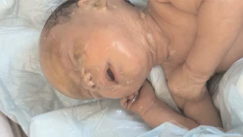 000 do umda bir görülür ve konjenital iktiyozislerin en ciddi formlar ndan biridir. Hastal n prenatal tan s n koymak çok nadir görüldü ü ve tipik ultrason görüntüsü olmad için zordur.