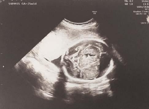 Poster Bildiri Özetleri fiekil 1 (PB-09): Fetal ultrasonografide saptanan intrakranial kitle. fiekil 2 (PB-09): Fetal manyetik rezonans görüntülemede intrakranial kitle.