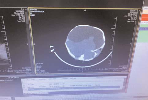 Spontan preterm eylem ve PPROM nedeniyle olan do umlar n iatrojenik olanlara göre ortalama 1 hafta erken geliflti i izlendi ( 29 hafta).