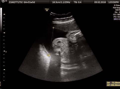 10. Ulusal Obstetrik ve Jinekolojik Ultrasonografi Kongresi, 27 30 Eylül 2018, Dalaman Amaç: Oldukça nadir görülen, fetal geliflme gerili ine neden olabilen ve fetal yutma güçlü ü nedeniyle