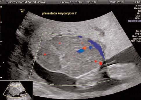 PB-18 Prenatal dönemde üç boyutlu power Doppler ultrasonografi ile tan konulmufl plasental koryoanjiom vakas Rauf Meleko lu 1, Ercan Y lmaz 1, Saadet Alan 2, fieyma Erkek 2, Ebru Çelik 3 1 nönü