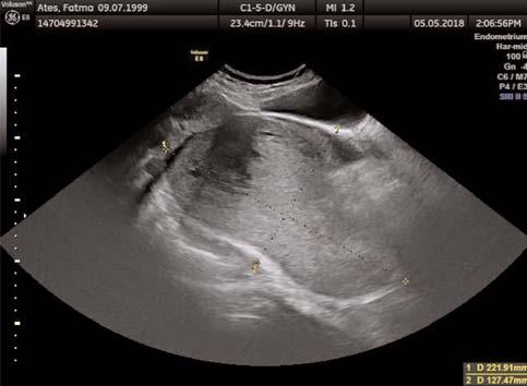 10. Ulusal Obstetrik ve Jinekolojik Ultrasonografi Kongresi, 27 30 Eylül 2018, Dalaman hafif LDH yüksekli i d fl nda bir patoloji saptanamad. Sa ovarian kitle düflünülerek laparatomiye karar verildi.