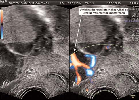 fiekil 2 (PB-21): Transvajinal ultrasonografi ile muayenede servikal os önünde fetal damarlar ile birlikte umbilikal kordonun velamentöz olarak internal servikal os üzerine insersiyonu.