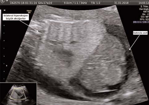 Abortus materyalinin patolojik incelemesinde fetüste Fraser sendromu düflündüren kriptoftalmus, bilateral renal agenezi, sa ve sol ellerde sindaktili, alt ekstremitede yap fl kl k ve imperfore anüs