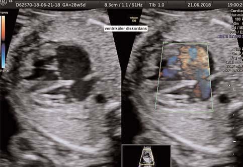 Fetal anatomik de erlendirmede bilateral böbrekler hiperekojen displastik görünümde ve omfolosel izlendi (fiekil 5 PB-22).