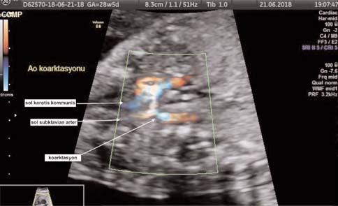 10. Ulusal Obstetrik ve Jinekolojik Ultrasonografi Kongresi, 27 30 Eylül 2018, Dalaman fiekil 2 (PB-23): Üç damar görüntüsünde büyük damarlar n boyutlar nda orant s zl k (aort rölatif olarak küçük)