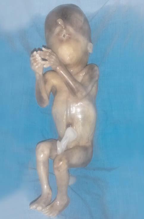 Ekstremitelerin incelenmesinde de el ve ayaklarda bilateral polidaktili saptandi (fiekil 3 PB- 42). Aile fetüs hakkinda bilgilendirildi.