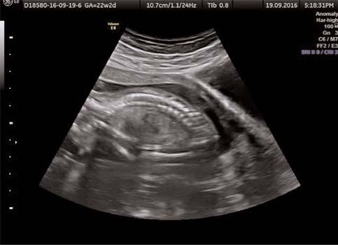 SAT a göre 18 hafta iken yap lan ultrason muayenesinde, fetüsün a rl n n %1 persantilin alt nda oldu u, amnion maiinin azald -, plasentan n kal nlaflt ve kistik alanlar içermekte oldu u, intestinal