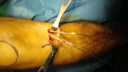 Resim9: Semitendinosus ve gracilis tendonlarının alınması 3.2.2 Greft hazırlanması Tendonlar, üzerindeki uzantılardan ve kasların kalan kısımlarından temizlenir.