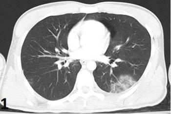 214 Acil Serviste Toraks BT / Thorax CT in Emergency Department Akciğer grafisi toraks acillerinde ilk ve en sık kullanılan radyolojik yöntem olmakla birlikte yetersiz kalabilmektedir.