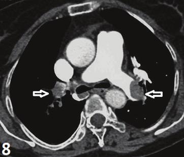 Durhan G., Akpınar GM. 217 Resim 8. Sağ ve sol pulmoner arterler içerisinde pulmoner tromboemboli ile uyumlu dolum defektleri görülmektedir (beyaz oklar). Resim 9.