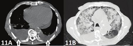 218 Acil Serviste Toraks BT / Thorax CT in Emergency Department Resim 11. Bilateral plevral efüzyon (oklar) ve perihiler yerleşimli konsolidasyonlar ile karakterize akciğer ödemi izlenmektedir. A. Mediasten penceresi.