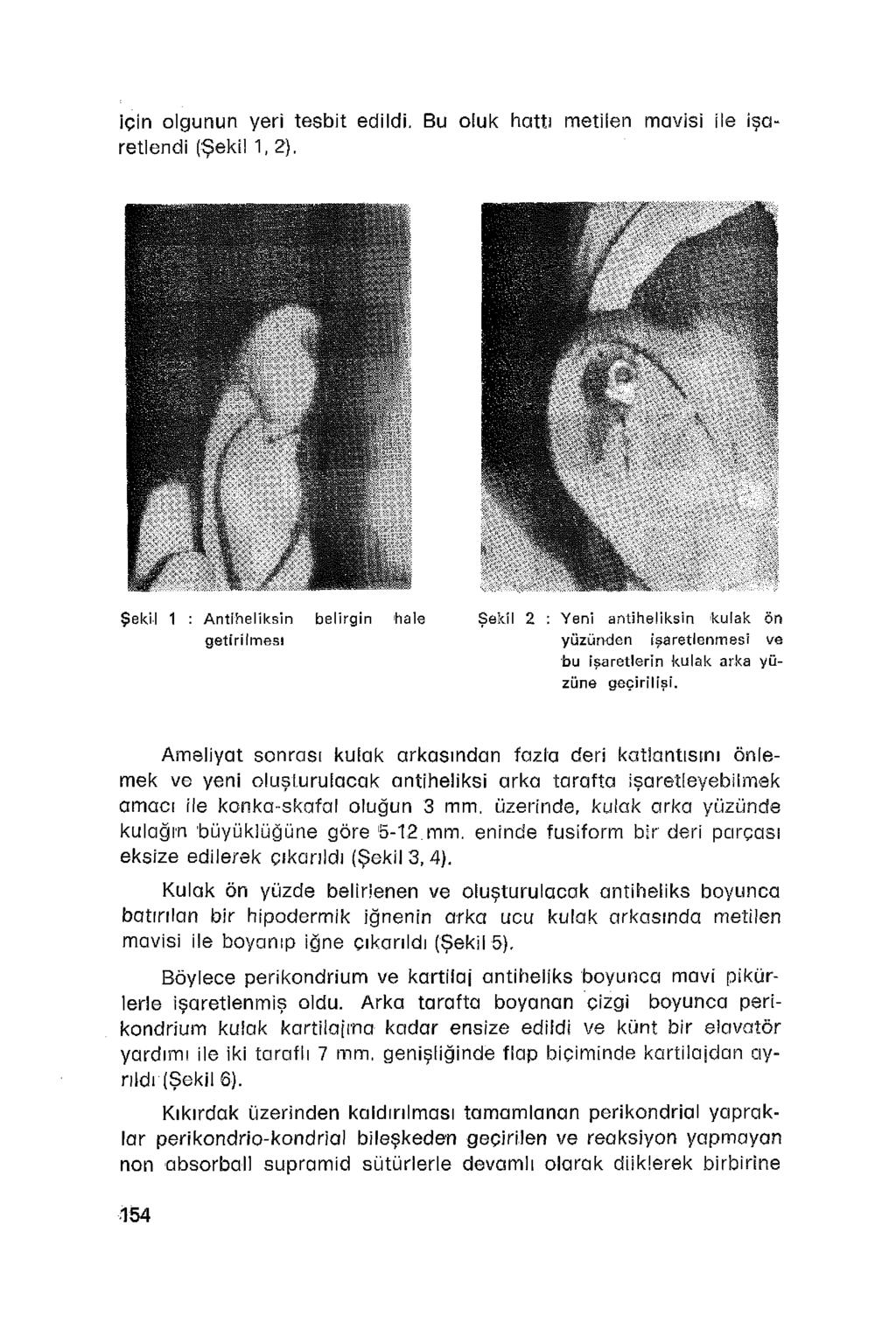 için olgunun yeri tesbit edildi. Bu oiuk hattı metilen mavisi ile işaretlendi (Şekil 1,2).